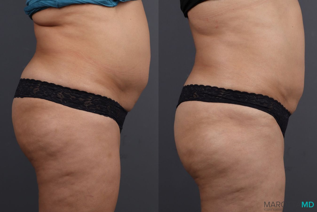 Before and after EMSCULPT® case 7247