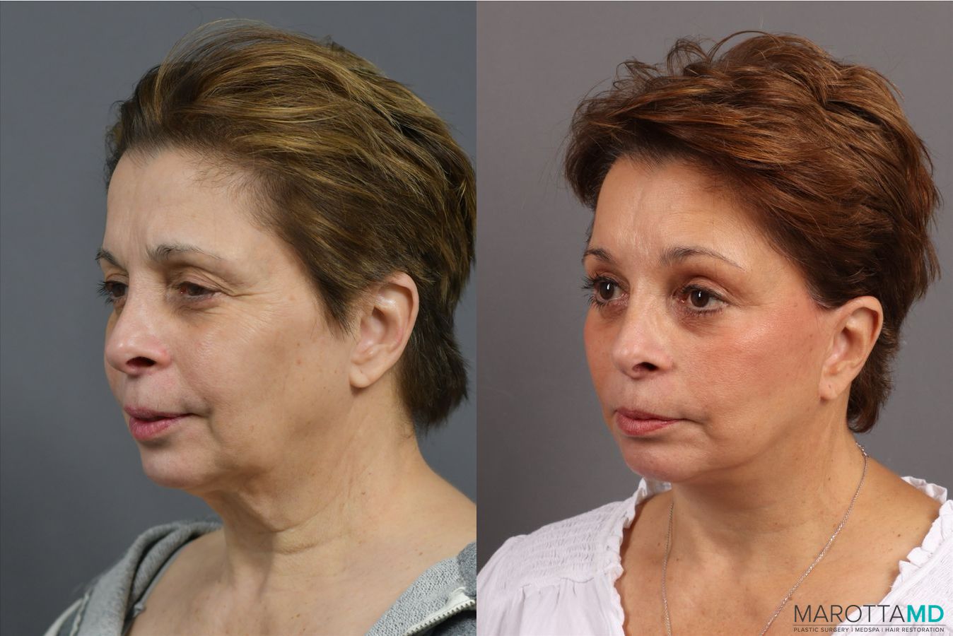 Before and after Endoscopic Brow Lift case 41933 - Angle 4