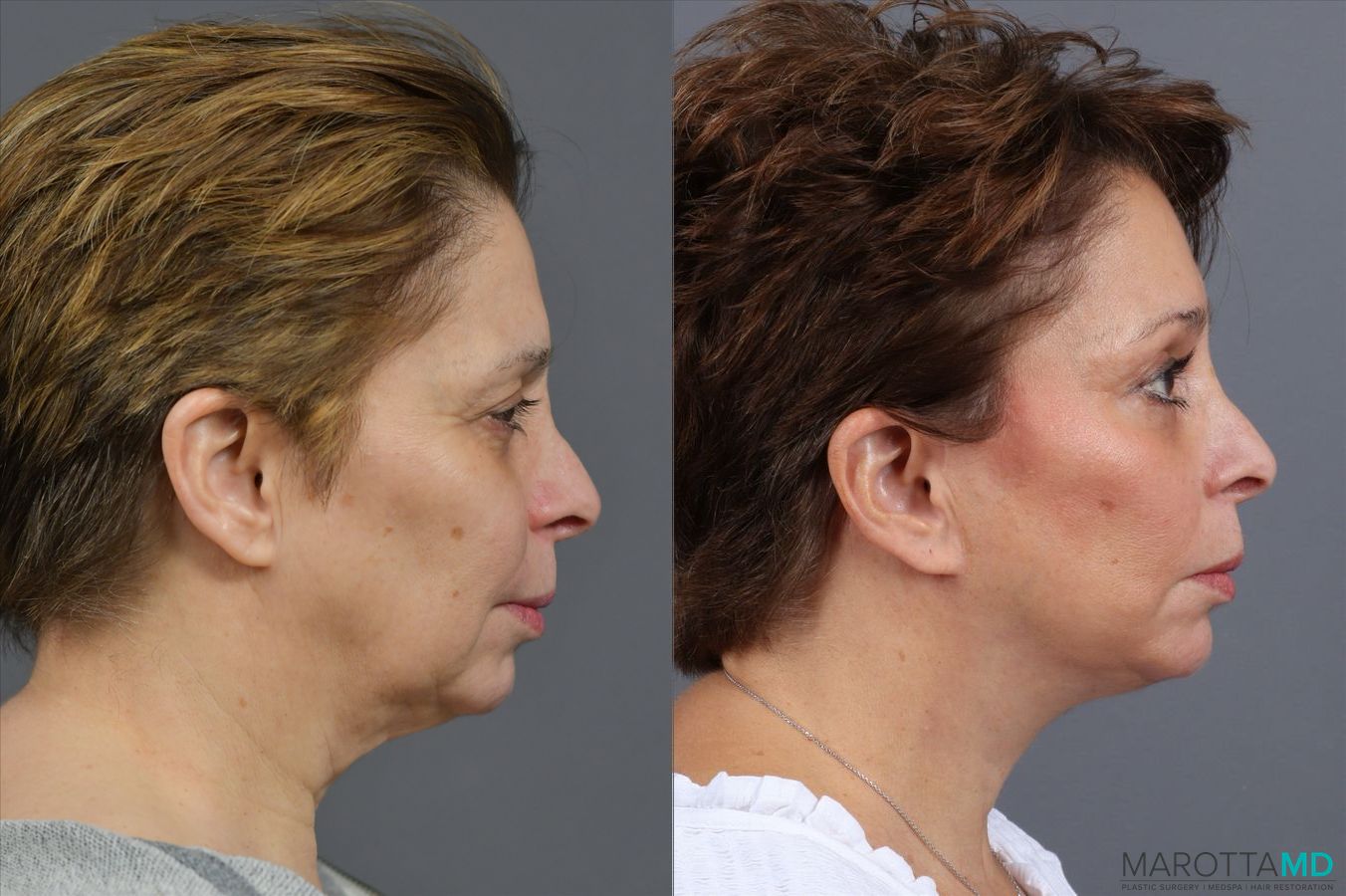 Before and after Endoscopic Brow Lift case 41933 - Angle 3