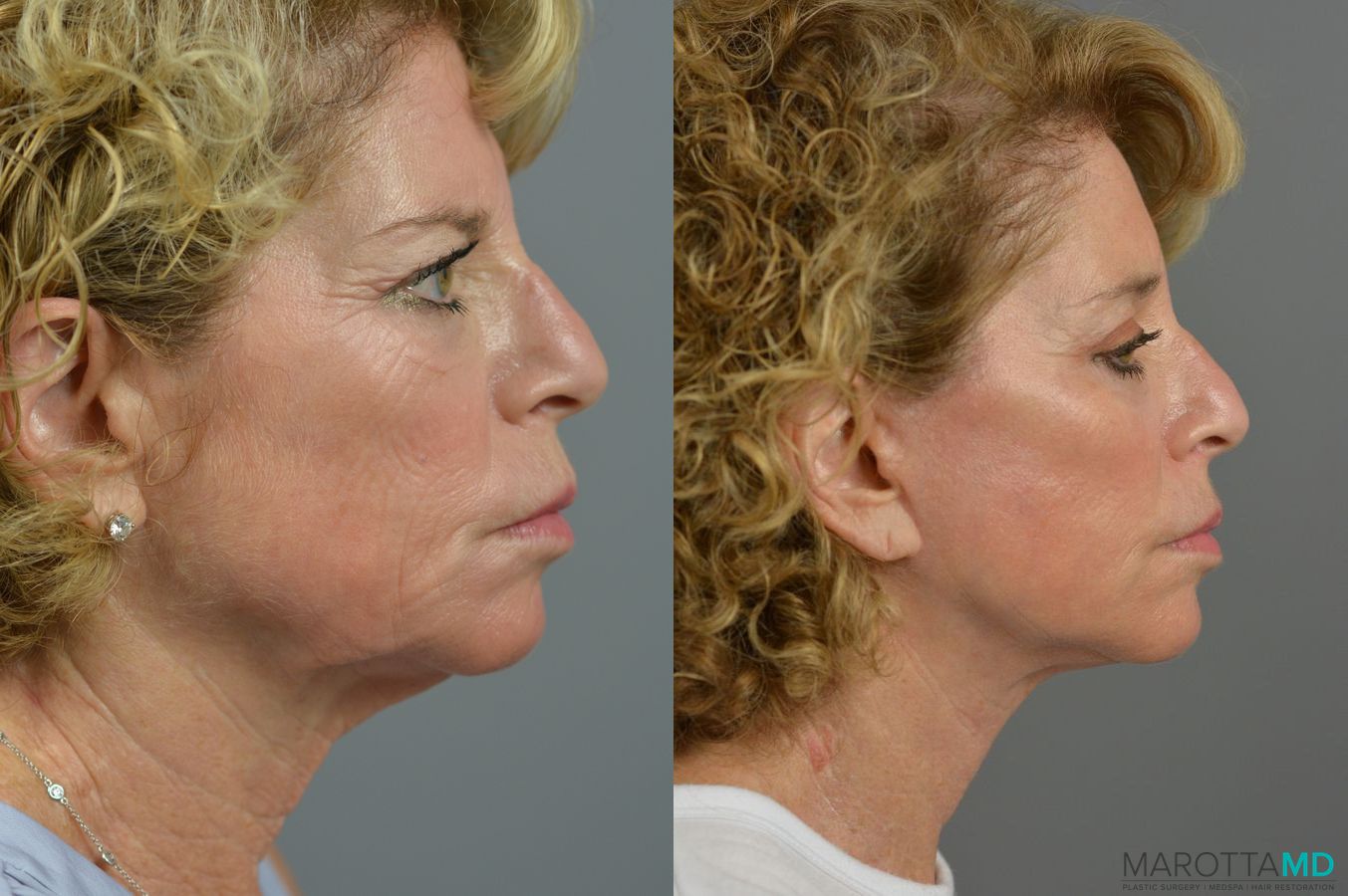 Before and after Endoscopic Brow Lift case 7281 - Angle 3