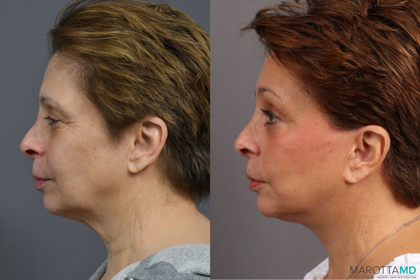 Before and after Endoscopic Brow Lift case 41933 - Angle 5