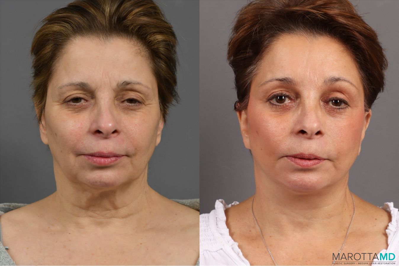 Before and after Endoscopic Brow Lift case 41933