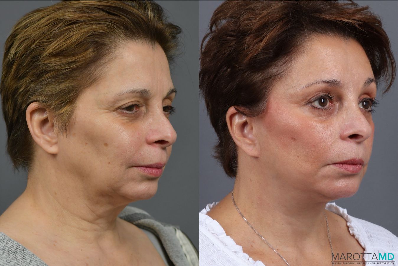 Before and after Endoscopic Brow Lift case 41933 - Angle 2