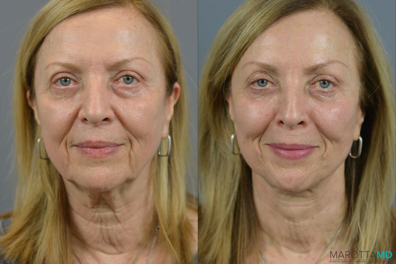 Before and after Facelift & Neck Lift case 21668