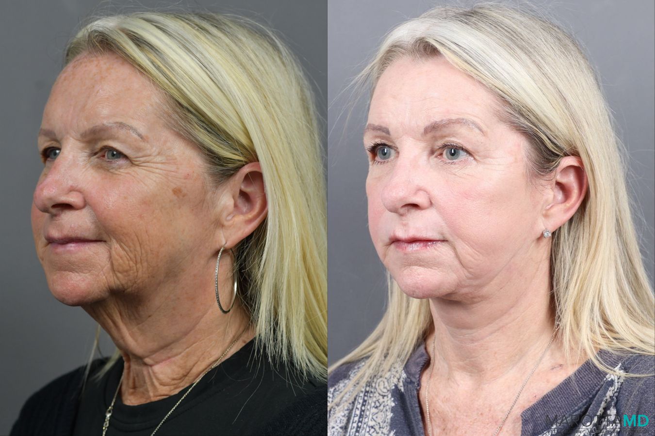 Before and after Facelift & Neck Lift case 17405 - Angle 4