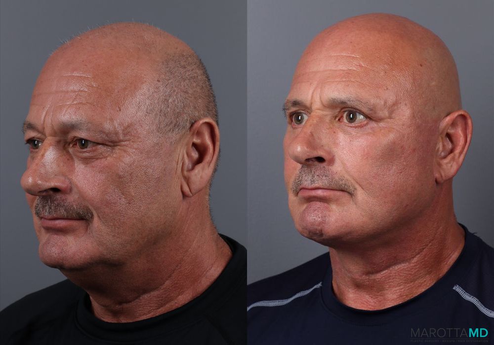 Blepharoplasty Lower - Thumbnail 4