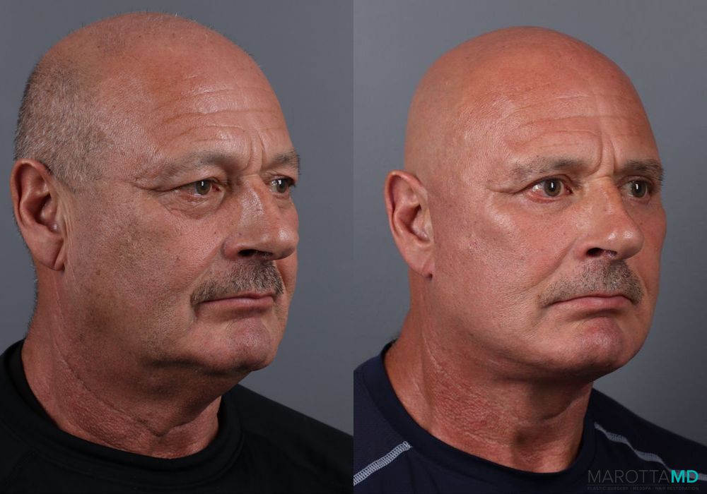 Blepharoplasty Lower - Thumbnail 2