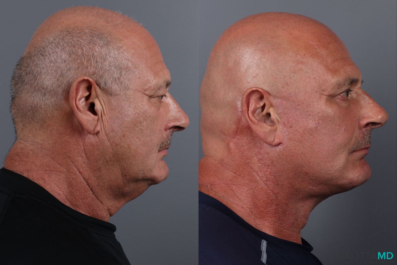 Before and after Blepharoplasty Upper case 19700 - Angle 3