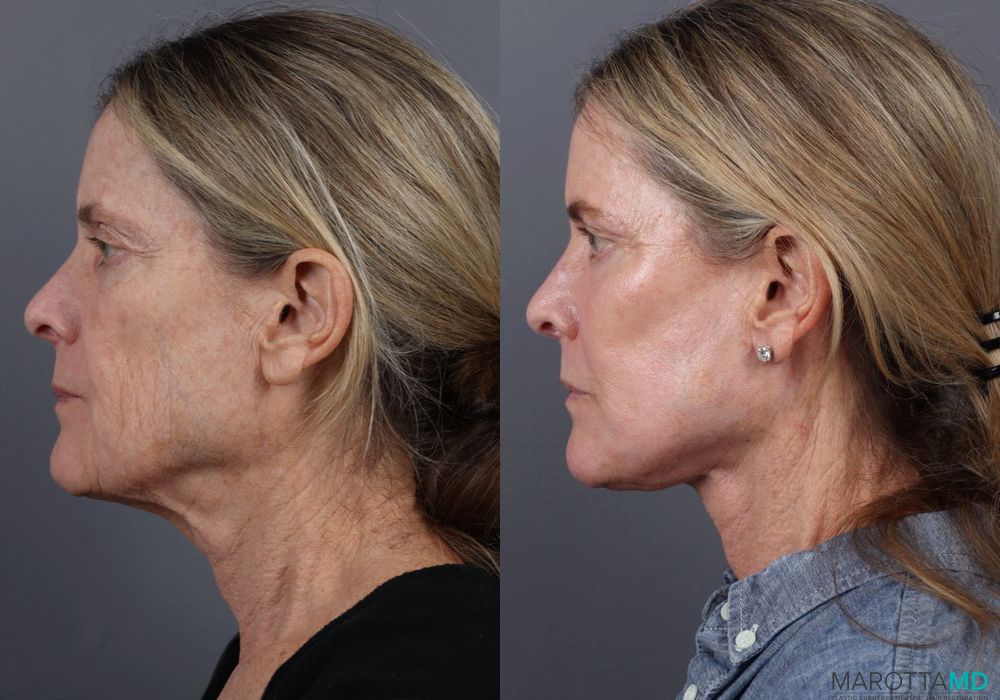 Blepharoplasty Lower - Thumbnail 5