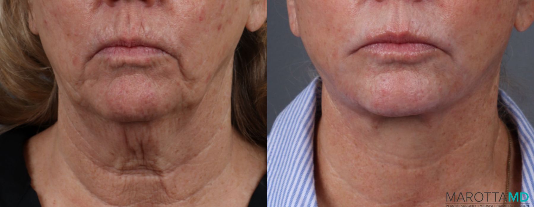 Facelift & Neck Lift - Case 978