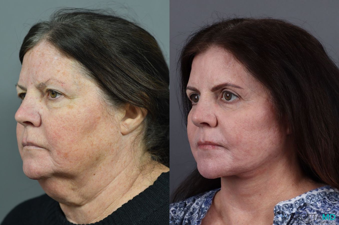Before and after Facelift & Neck Lift case 7034 - Angle 4
