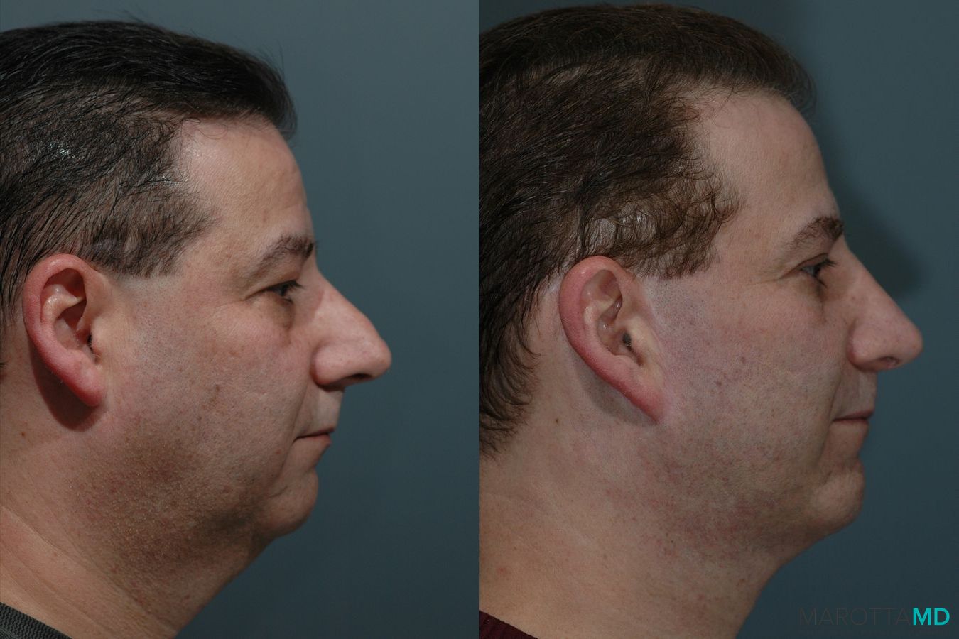 Before and after Facelift & Neck Lift case 7108 - Angle 3