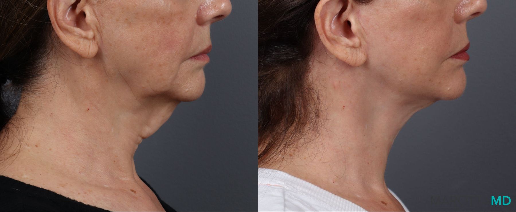 Before and after Facelift & Neck Lift case 19692 - Angle 3