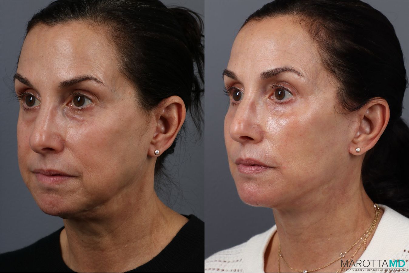 Before and after Fat Transfer - Face case 41866 - Angle 4