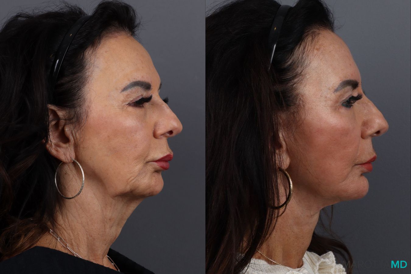 Before and after Facelift & Neck Lift case 12922 - Angle 3
