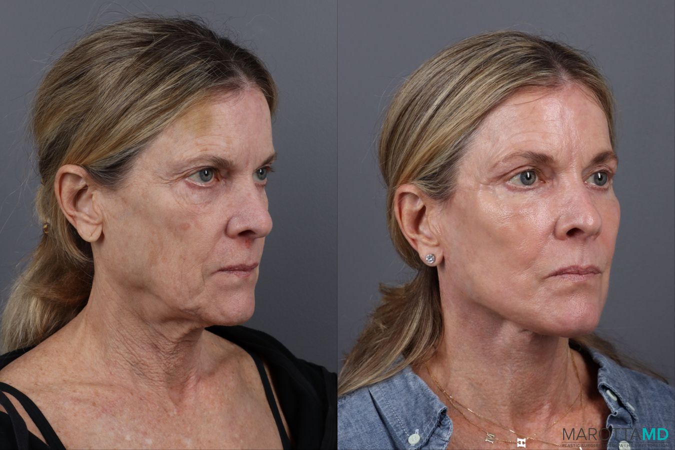 Before and after Blepharoplasty Lower case 19695 - Angle 2