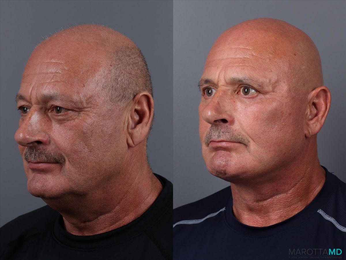Before and after Blepharoplasty Upper case 19700 - Angle 4