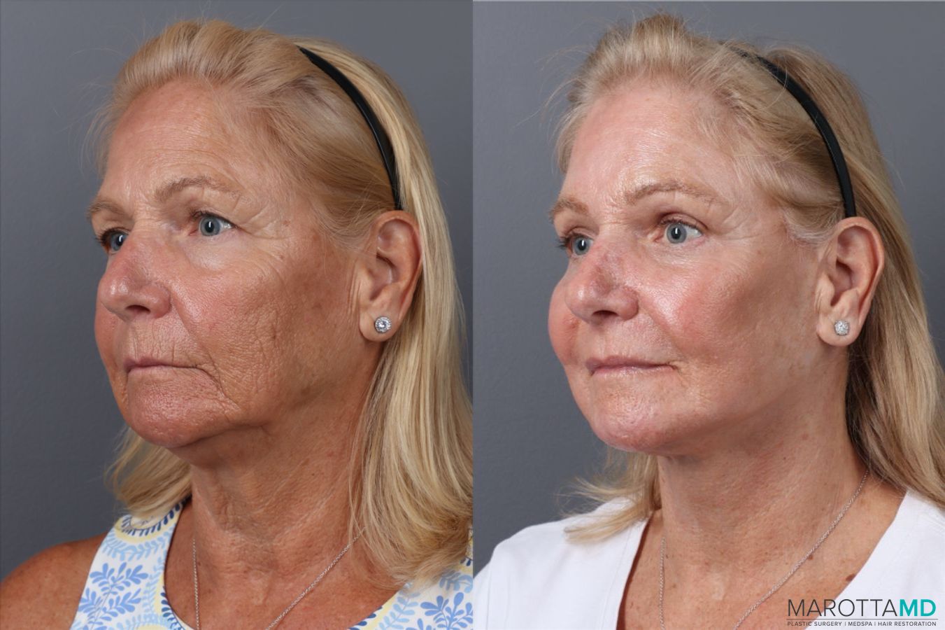 Before and after Laser Skin Resurfacing case 43233 - Angle 4