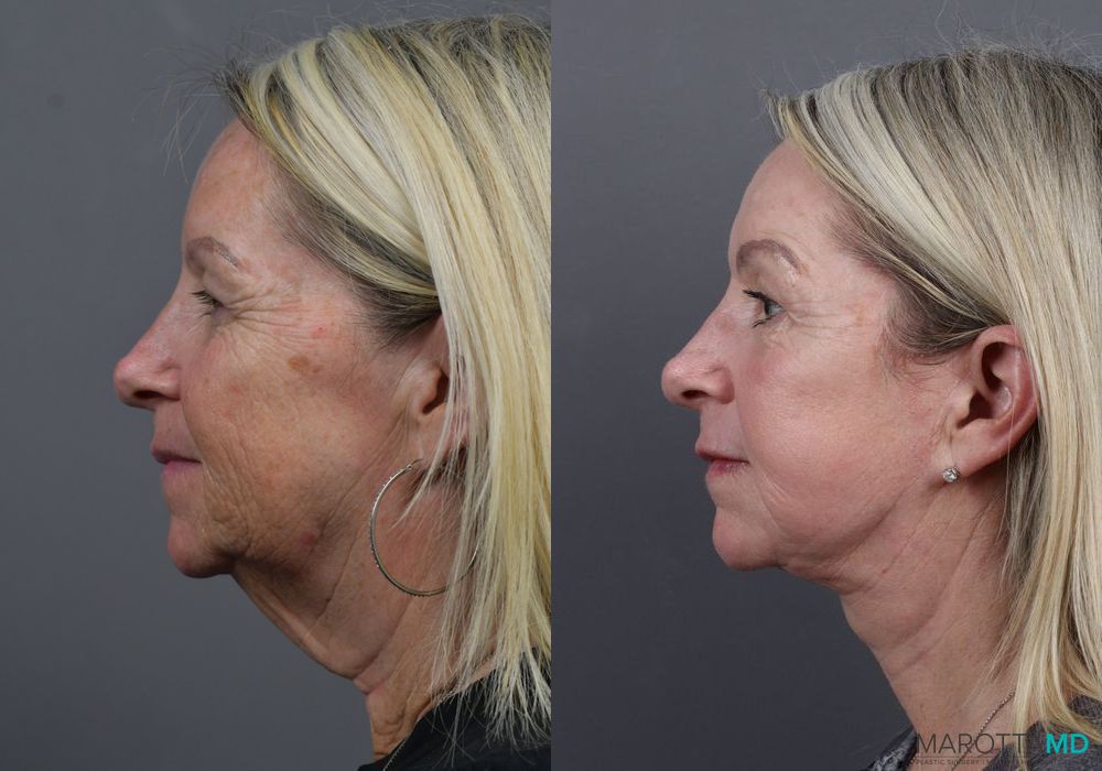Facelift & Neck Lift - Thumbnail 5