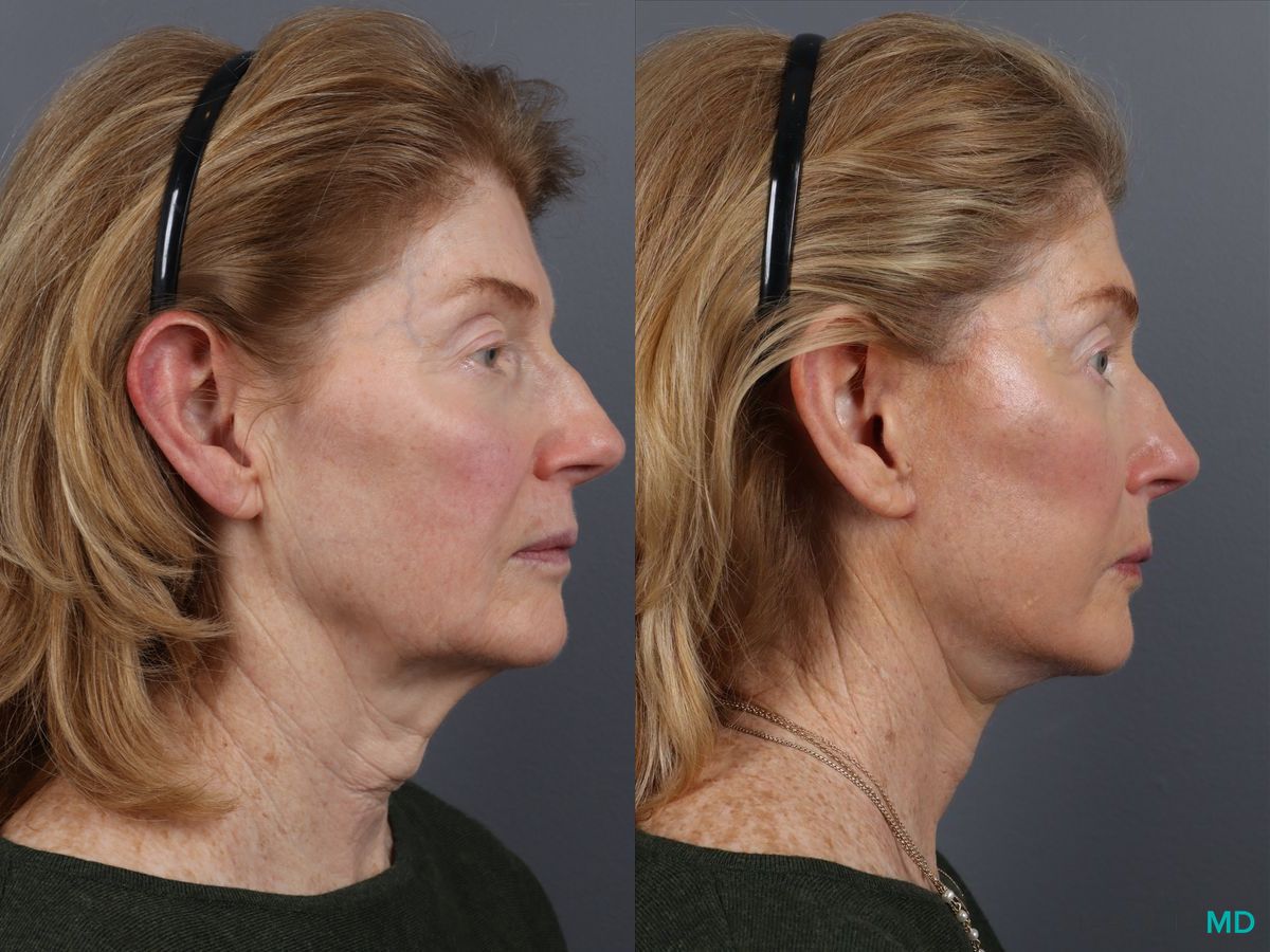 Before and after Facelift & Neck Lift case 12827 - Angle 3