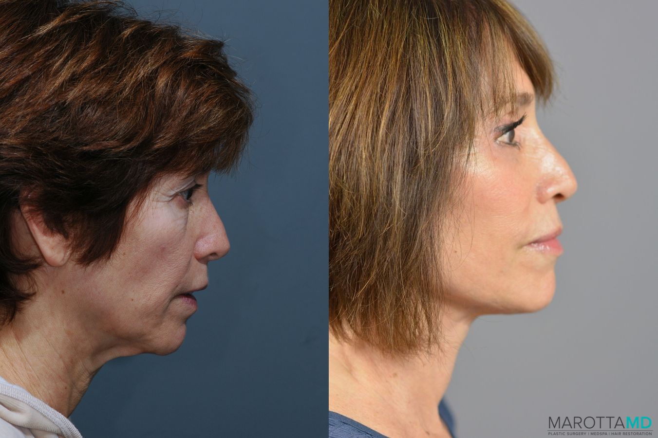 Before and after Facelift & Neck Lift case 6996 - Angle 2