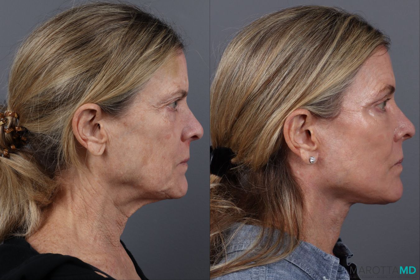 Before and after Blepharoplasty Lower case 19695 - Angle 3