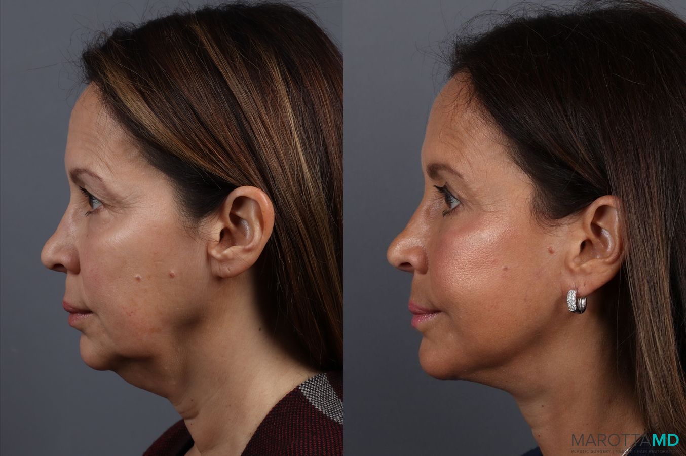 Before and after Facelift & Neck Lift case 7092 - Angle 5