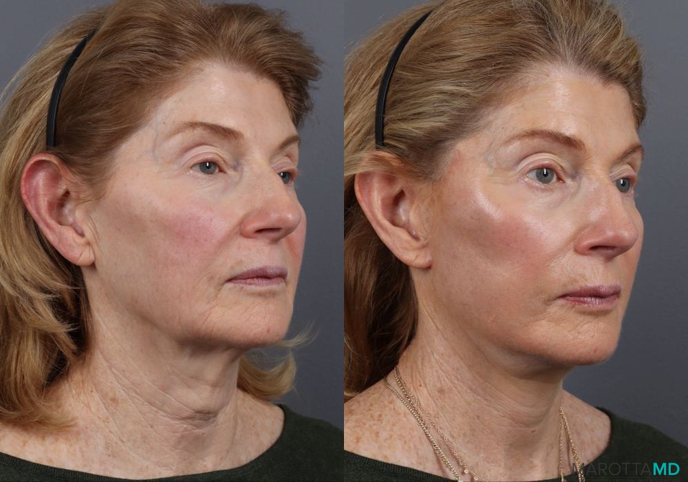 Facelift & Neck Lift - Thumbnail 2