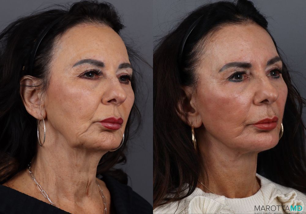 Facelift & Neck Lift - Thumbnail 2