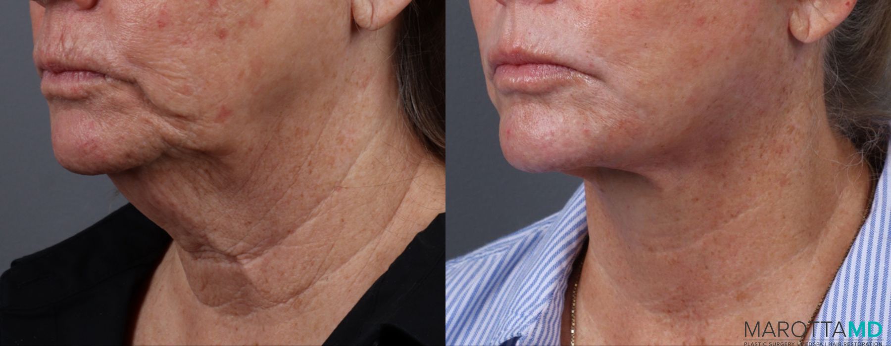 Facelift & Neck Lift - Thumbnail 4