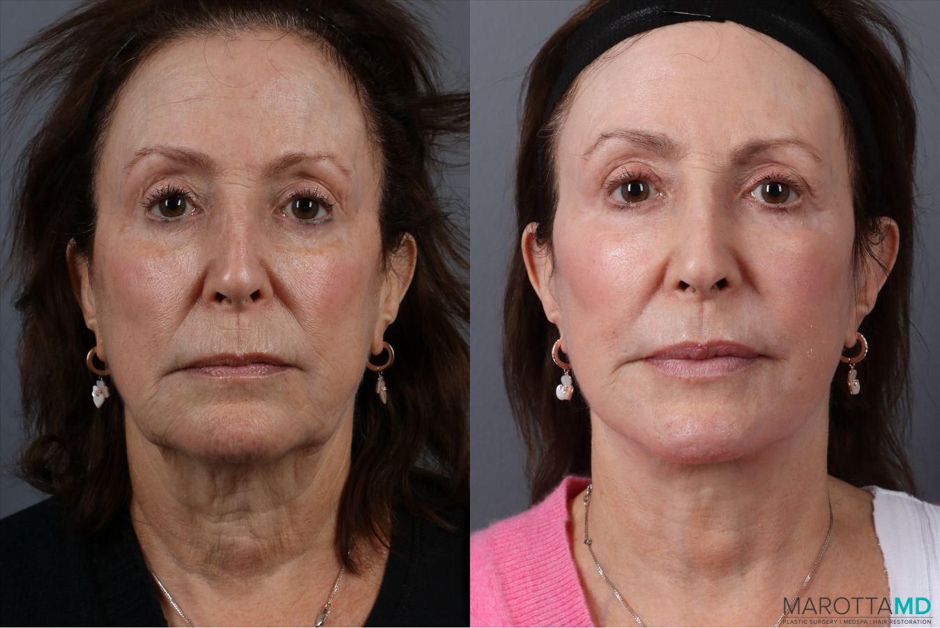 Before and after Laser Skin Resurfacing case 41861