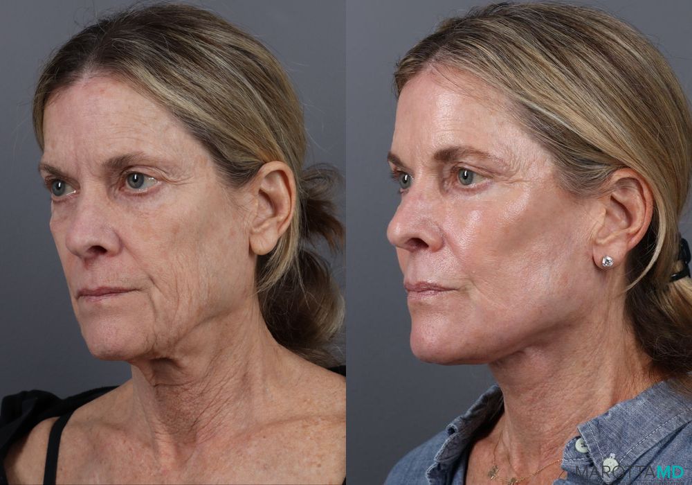 Blepharoplasty Lower - Thumbnail 4