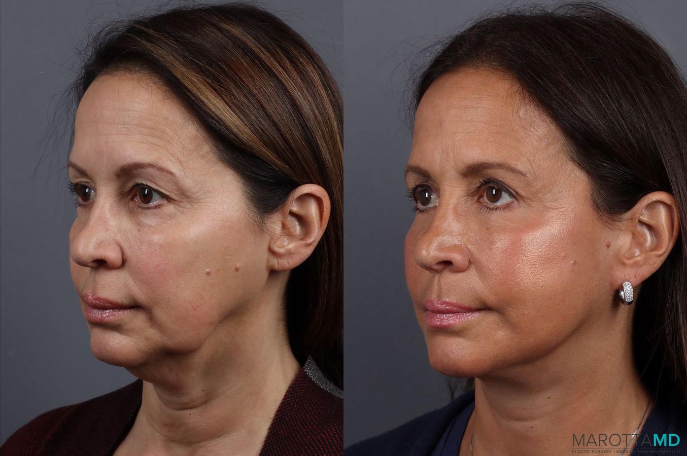 Before and after Facelift & Neck Lift case 7092 - Angle 4