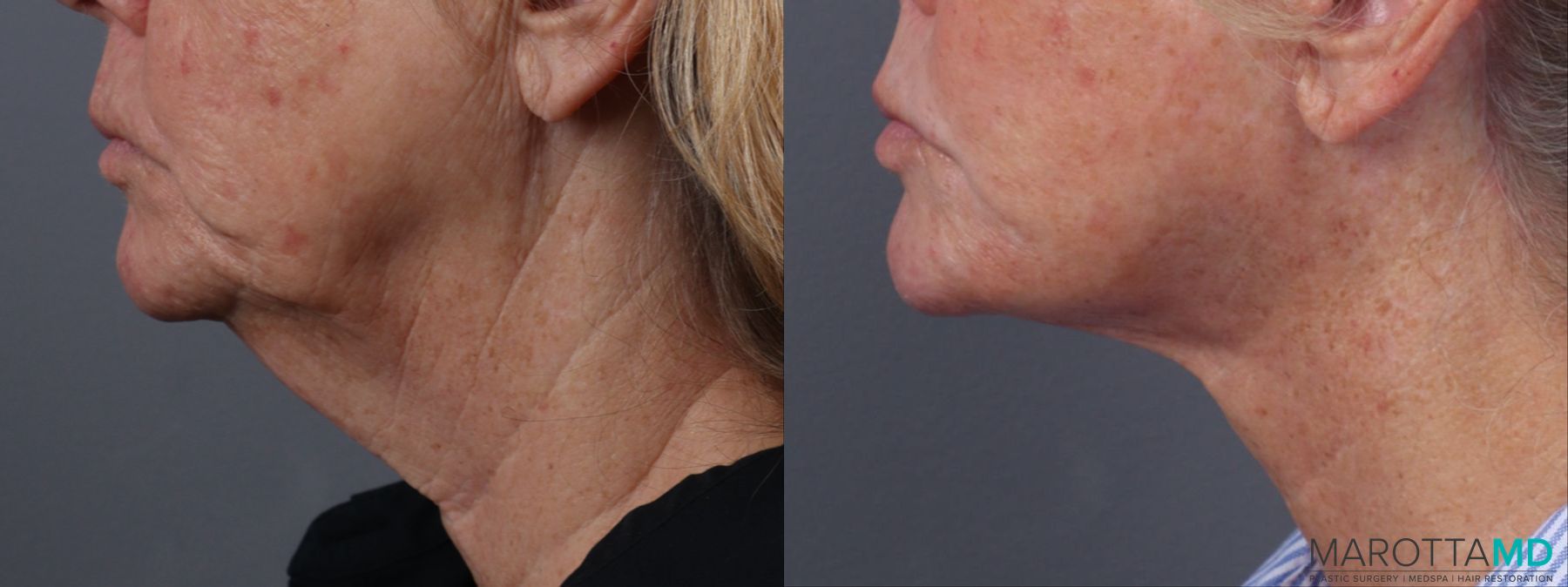 Before and after Fat Transfer - Face case 23768 - Angle 5