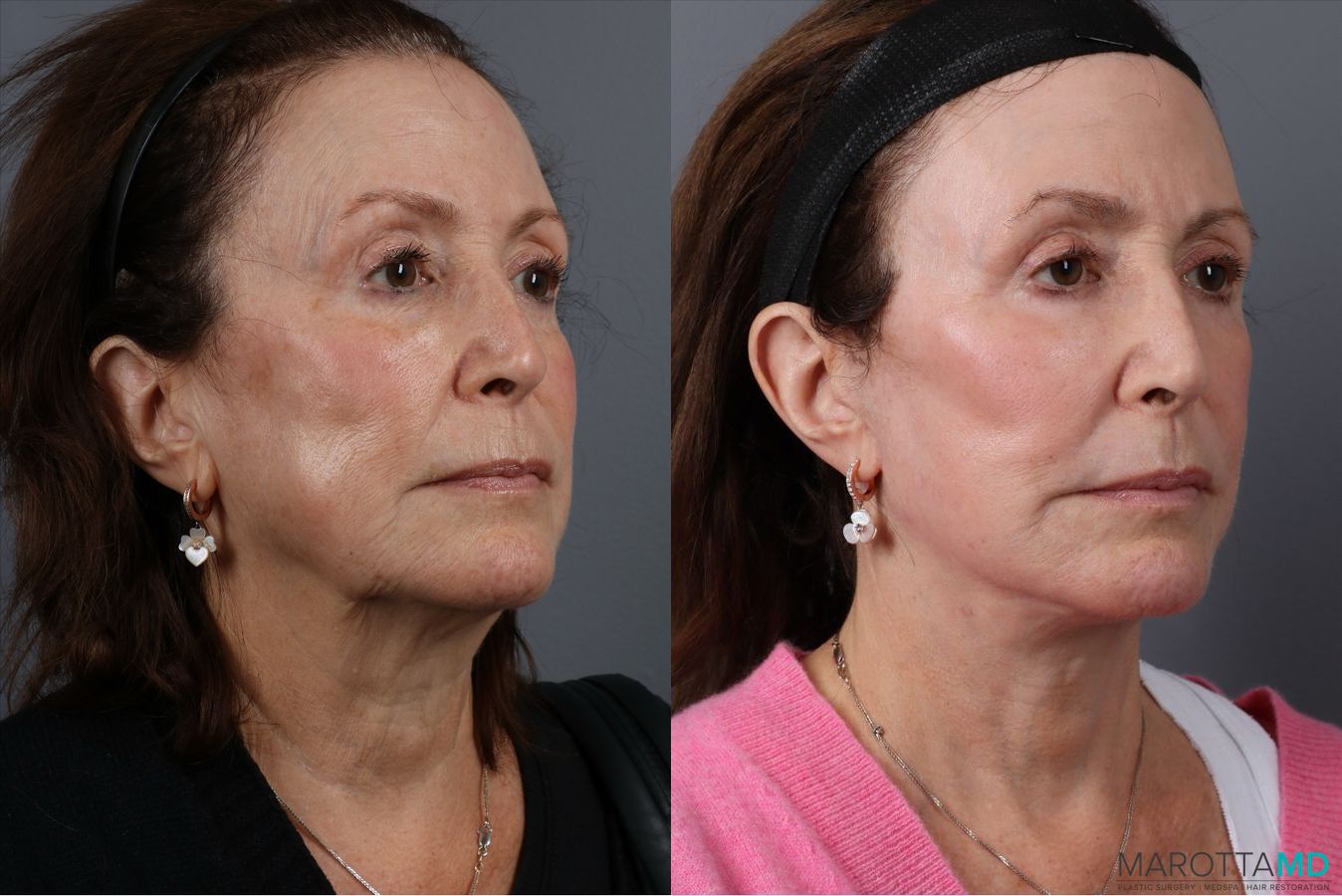 Before and after Laser Skin Resurfacing case 41861 - Angle 2