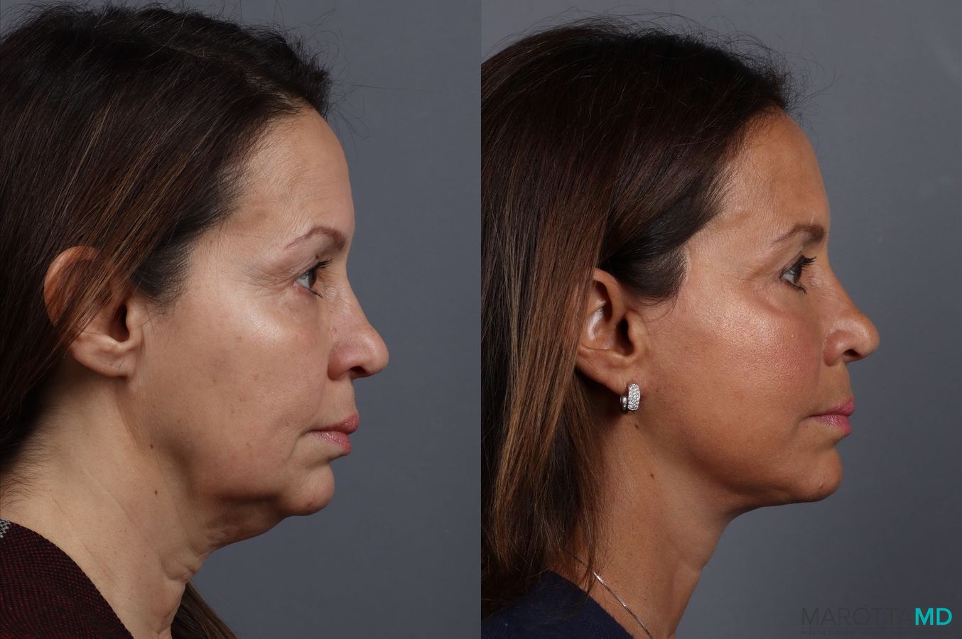 Before and after Facelift & Neck Lift case 7092 - Angle 3