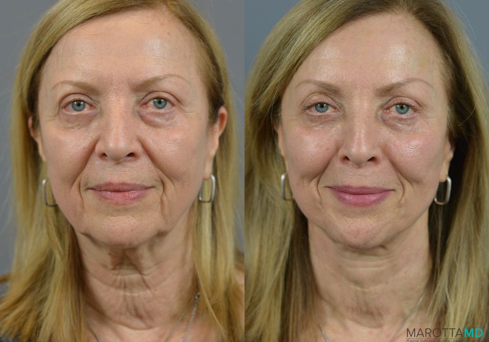 Facelift & Neck Lift - Case 206