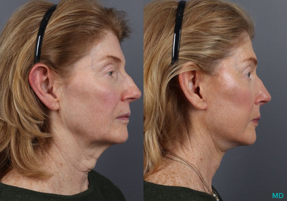Facelift & Neck Lift - Thumbnail 3