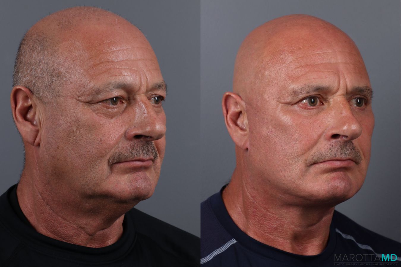 Before and after Blepharoplasty Upper case 19700 - Angle 2