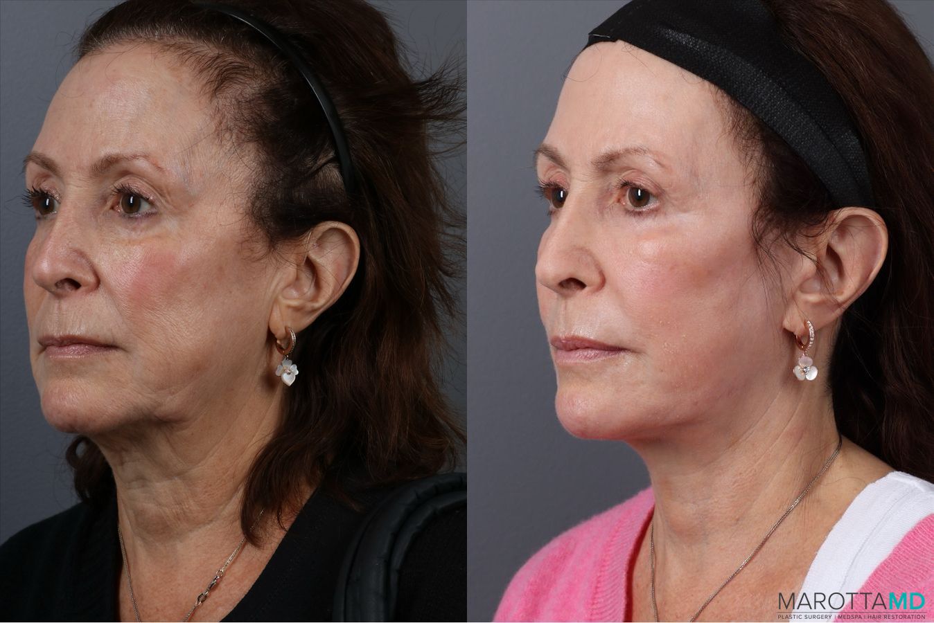 Before and after Laser Skin Resurfacing case 41861 - Angle 4