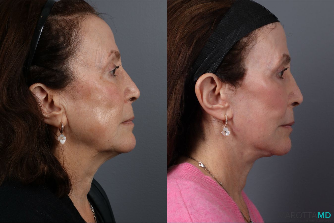 Before and after Laser Skin Resurfacing case 41861 - Angle 3