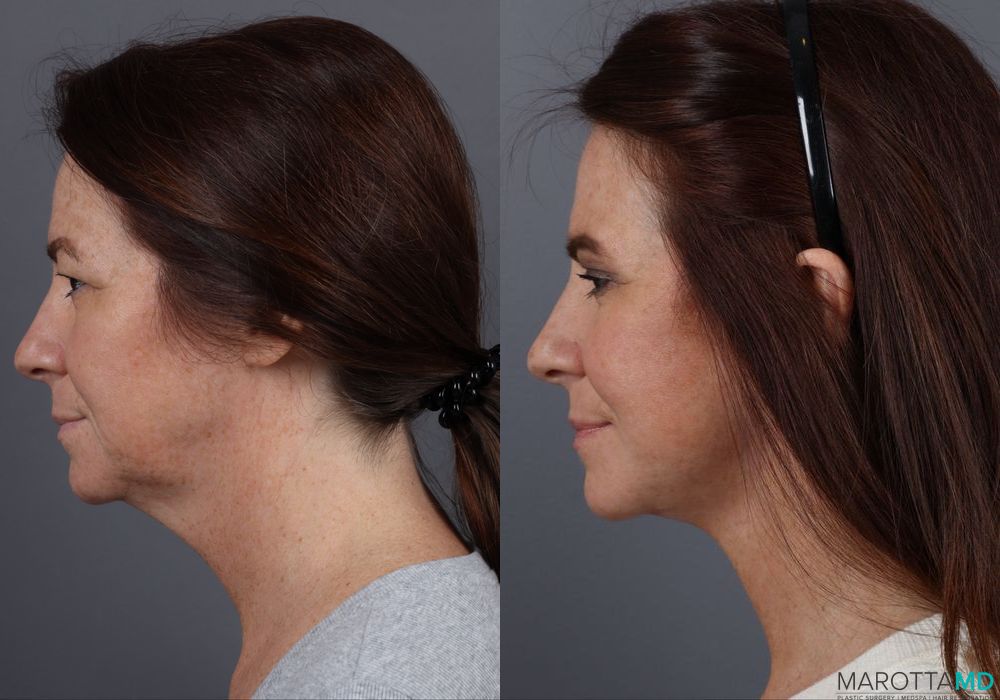 Before and after Facelift & Neck Lift case 12316 - Angle 5