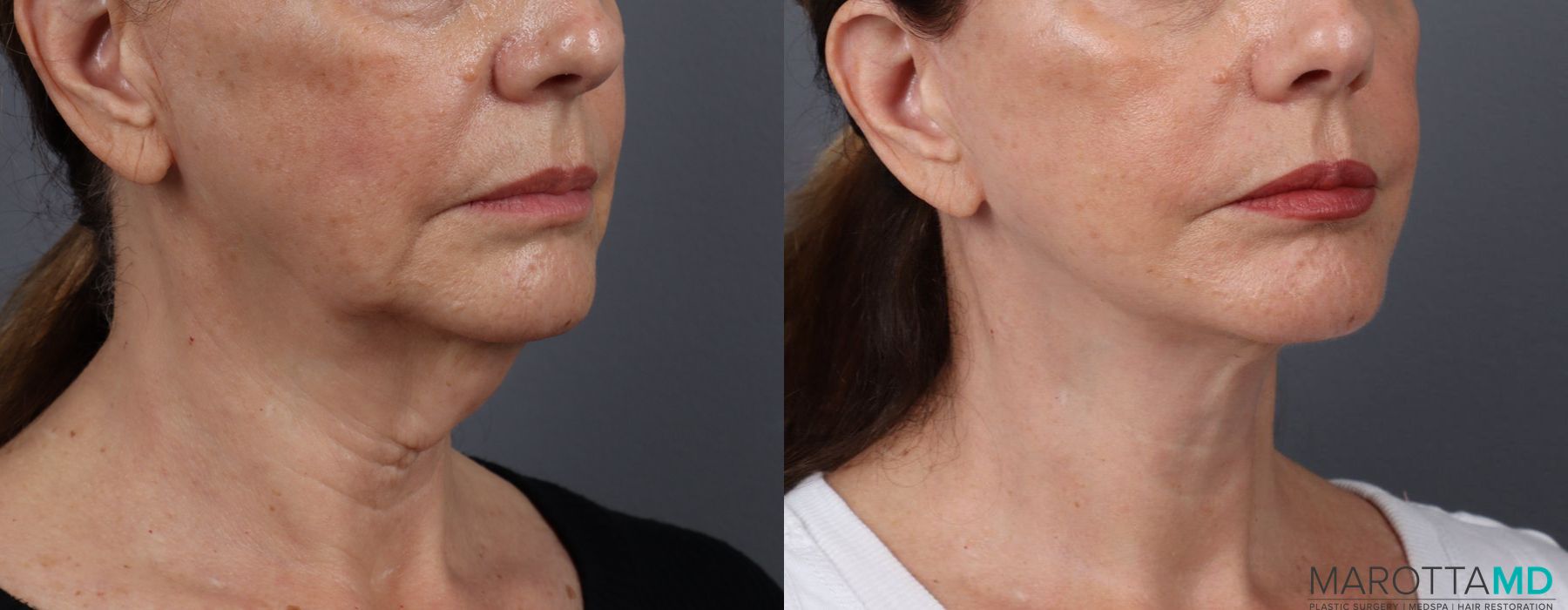 Facelift & Neck Lift - Thumbnail 2