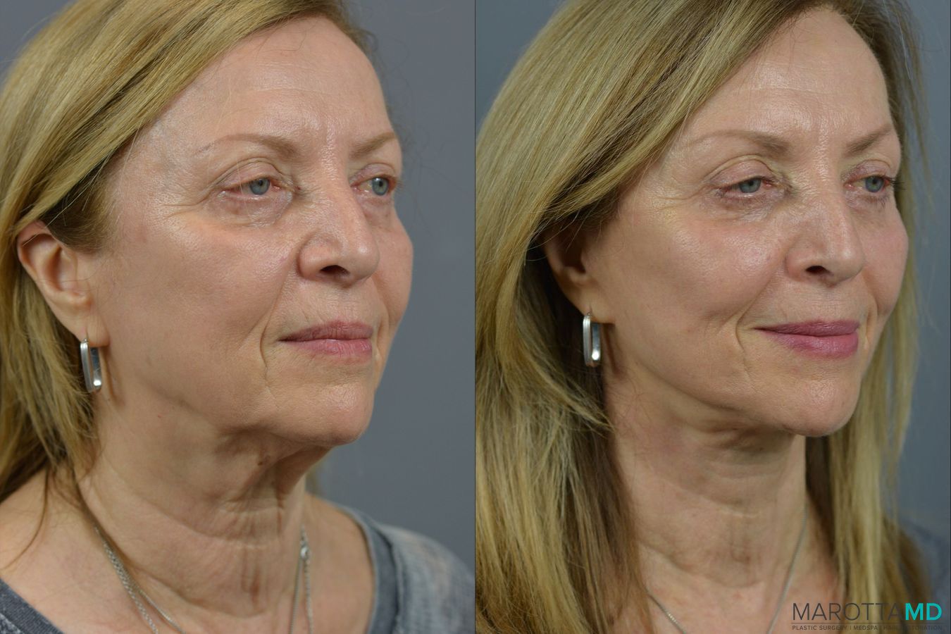 Before and after Facelift & Neck Lift case 21668 - Angle 5
