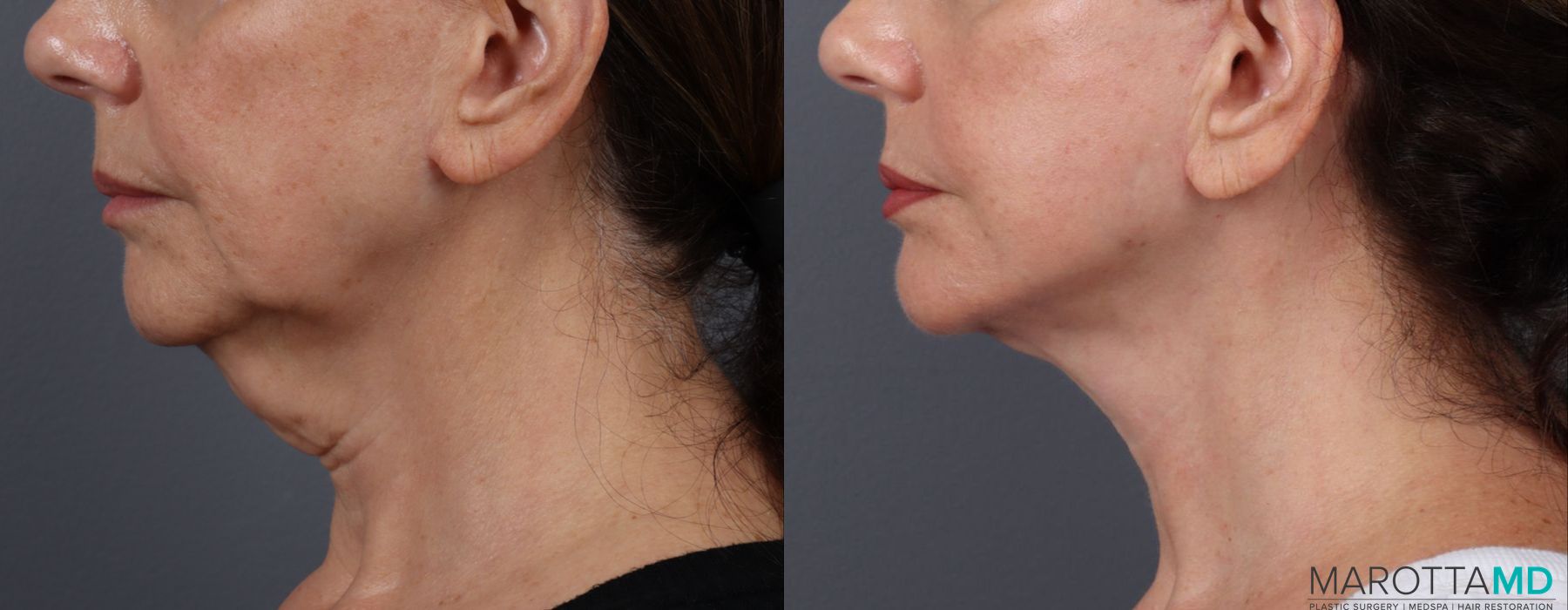 Facelift & Neck Lift - Thumbnail 5