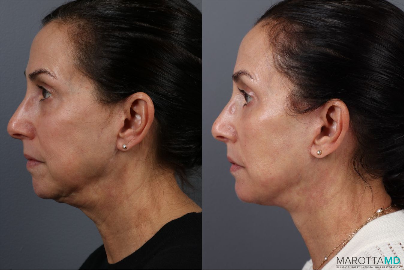 Before and after Fat Transfer - Face case 41866 - Angle 5