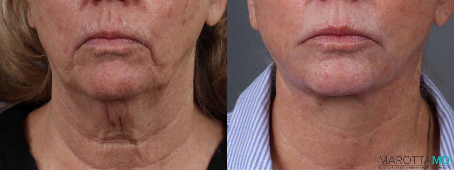Before and after Fat Transfer - Face case 23768