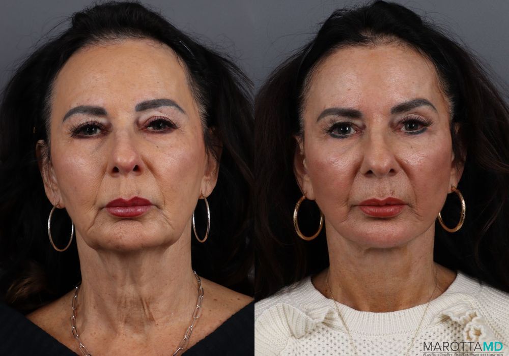 Facelift & Neck Lift - Case 194