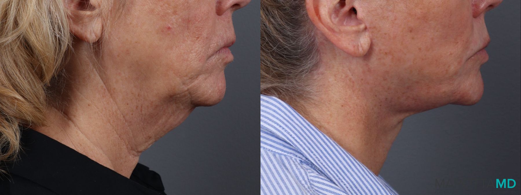Before and after Fat Transfer - Face case 23768 - Angle 3
