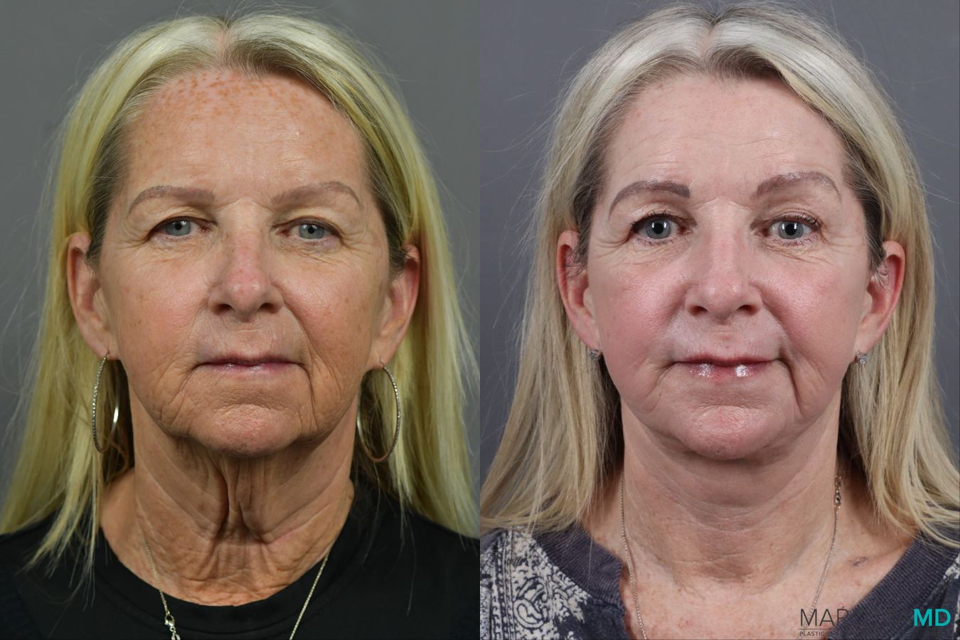 Before and after Facelift & Neck Lift case 17405